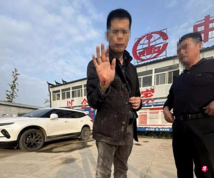 记者王文志展示被打出血的右手